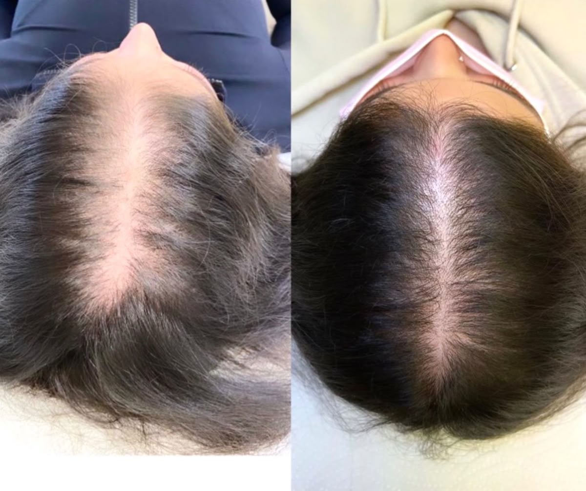 Anti-Hair Fall Treatment